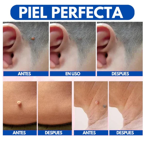 WART REMOVEDOR: Removedor de arrugas y lunares
