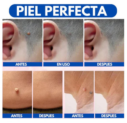 WART REMOVEDOR: Removedor de arrugas y lunares